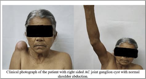 Clinical Photograph Of The Patient With Right Sided Ac Joint Ganglion