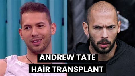 Andrew Tate Hair Transplant How Did It Proceed Youtube