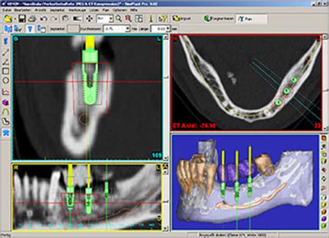The transformation of preoperative planning into a precise surgical outcome using cas depends on location, surgical. Computer Guided Implant Surgery Archives | Dr. Spiro Karras