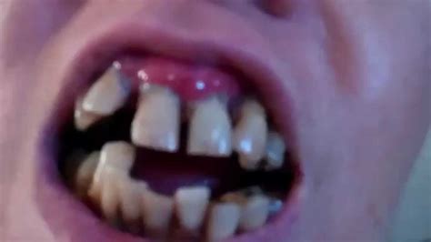 worst teeth ever what happened youtube