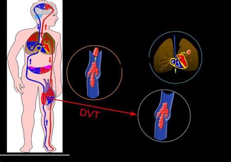 Deep Venous Thrombosis And Its Major Complication Pulmonary Embolism