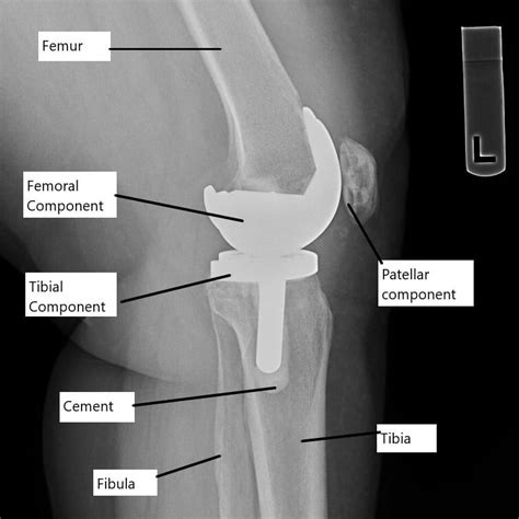 Pain After Knee Replacement Complete Orthopedics Multiple Ny Locations