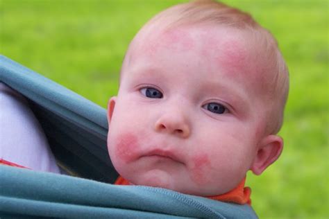 How To Effectively Apply Ringworm Treatment For Toddlers