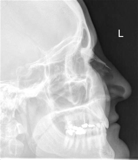 Nasal Bone Fracture Radiograph