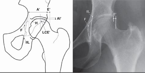 Schematic Left And Radiographic Right Presentations Of Coxa