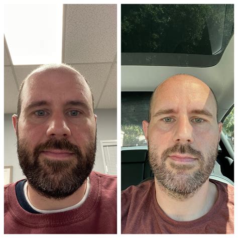 2 weeks at 2.5 : r/Mounjaro