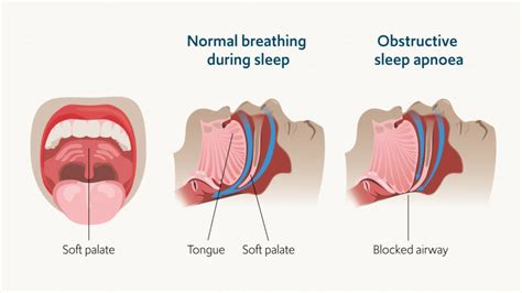 what is sleep apnea and how do you know if you have it in adelaide greenolivescafephilly