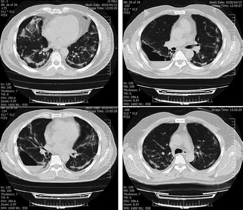 Chest Ct Scan With Lung Abscess Download Scientific Diagram