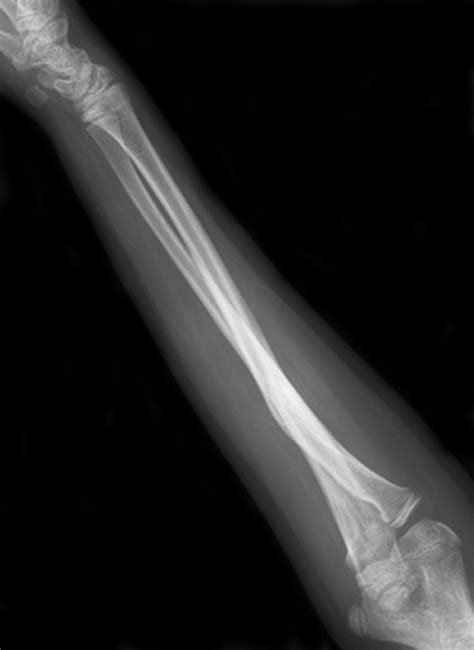 Outcome After Corrective Osteotomy For Malunited Fractures Of The