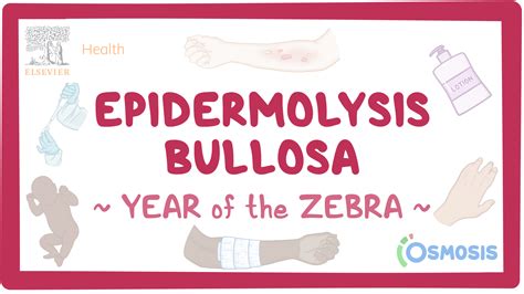Epidermolysis Bullosa Year Of The Zebra Video Osmosis