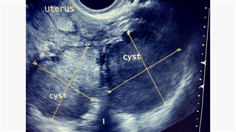 Endometriosis Ultrasound Images