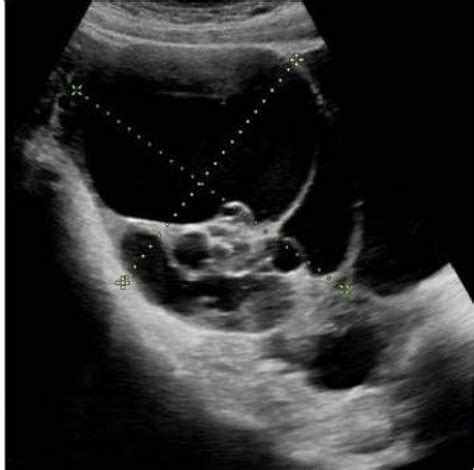 Ovarian Mass With Cystic And Solid Components On Ultrasound Source