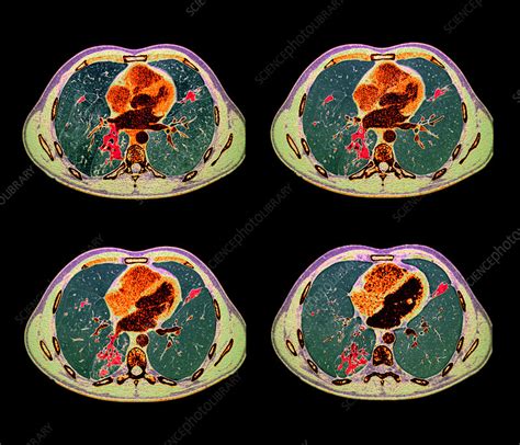 Tuberculosis Ct Scans Stock Image M2700318 Science Photo Library