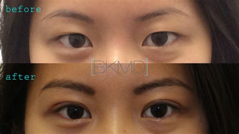 Asian Double Eyelid Photos Dr Brett Kotlus