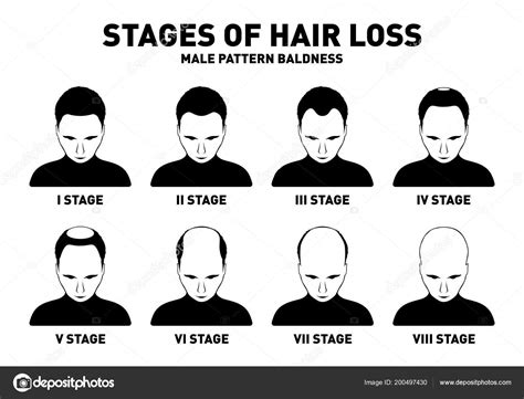 Male Pattern Baldness Types Ph