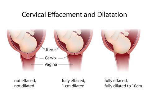 Effaced Cervix