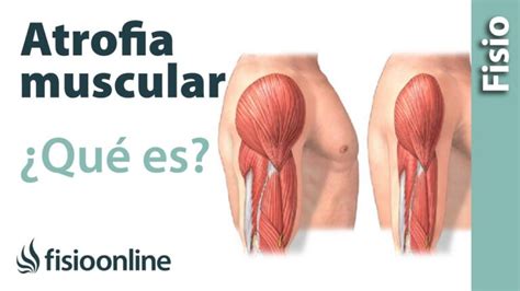 Qu Es La Atrofia Muscular Cuales Son Sus Causas Y Tratamiento