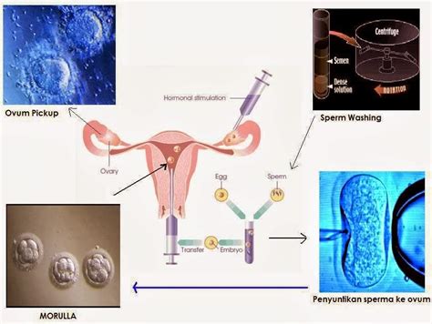 Proses Menunggu Setelah Transfer Embrio Bayi Tabung Cara Agar Cepat Hamil