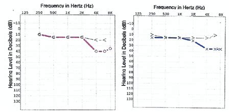 Conductive Mild Hearing Loss Audiogram Download Scientific Diagram