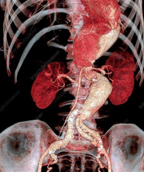 Arterial Aneurysms In Marfan Syndrome CT Stock Image C023 9811