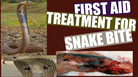 First Aid Treatment For Snake Bite Youtube