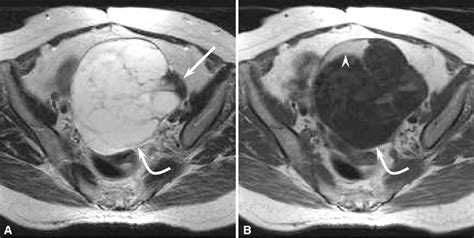 Ovarian Mucinous Cystadenoma Coexisting With Benign Brenner Tumor Mr