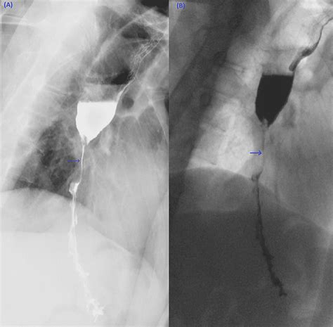 Cureus Severe Esophageal Stricture Caused By Esophageal Candidiasis In A Non HIV Patient