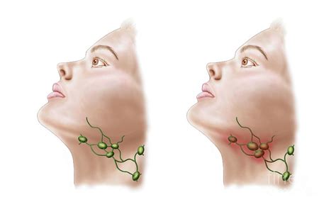 Anatomy Of Swollen Lymph Nodes Digital Art By Stocktrek Images