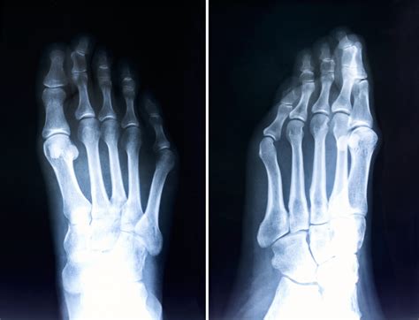 Types Of Foot Deformities Joint Replacement Institute