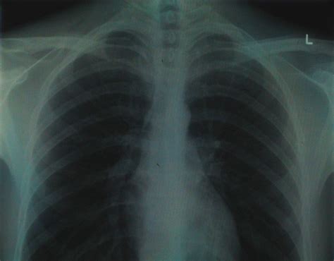 Cystic fibrosis | care guidelines for nutrition management. X-Ray Imaging Technique Allows Scientists to See Cystic ...
