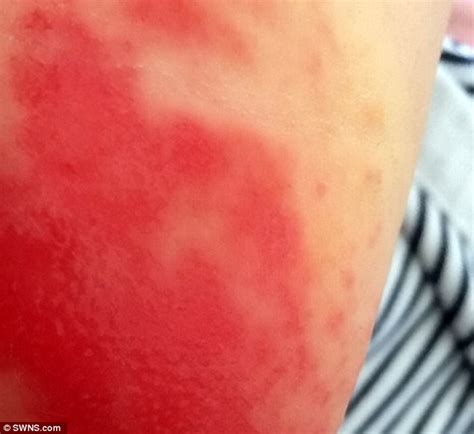 Morrisons Nappies Leave Baby With Horrific Bleeding Chemical Burns On