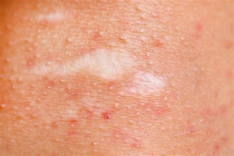 From Mild To Severe 10 Bacterial Skin Infections To Know Facty Health
