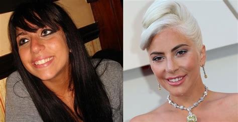 Did Lady Gaga Have Plastic Surgery Face Before And After