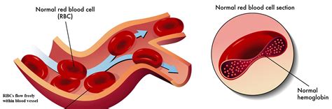 Some patients are advised to take prescribed or over the counter. Difference Between Normal Hemoglobin and Sickle Cell ...