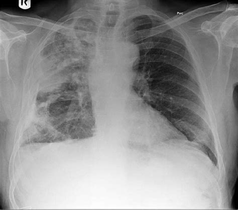 The Calcified Lung Nodule What Does It Mean Scienceopen