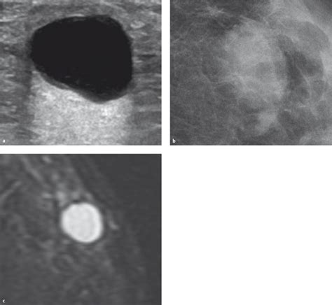 Imaging Of Breast Lesions Radiology Key
