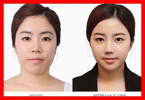 Before And After Photos Of Korean Plastic Surgery Part 2 62 PICS