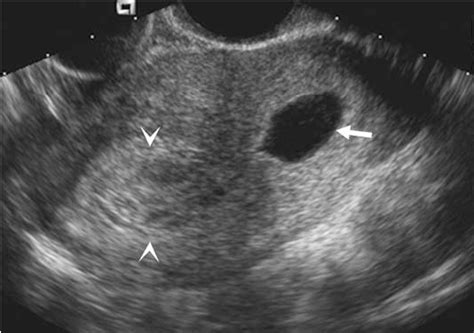 Figure 1 From Sonographic Evaluation Of First Trimester Bleeding