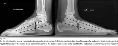 Figure From Reliability And Validity Of Radiographic Measurements In Hindfoot Varus And Valgus