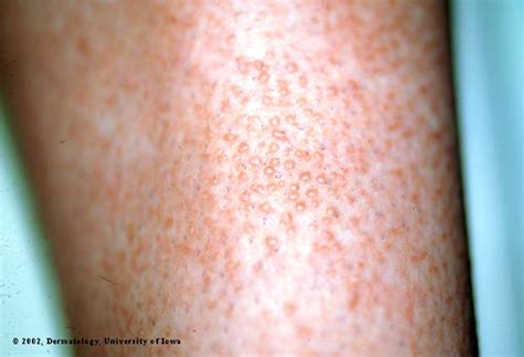 Lichen Amyloidosis Department Of Dermatology