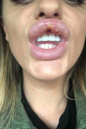 Lip Fillers Nightmare Woman S Lips Suffers Artery Occlusion Dr