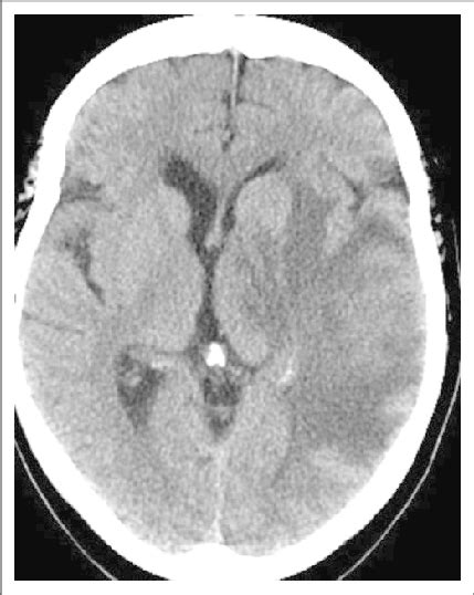 That image is visually examined by the expert radiologist for diagnosis of brain tumor. Noncontrast computed tomography (CT) scan of the brain ...