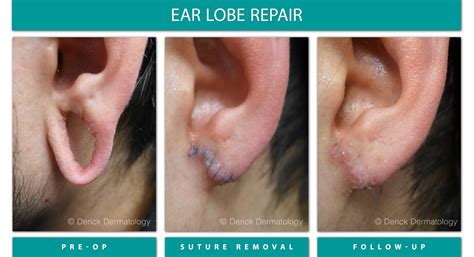 Before And After Gallery Ear Lobe Repair Derick Dermatology