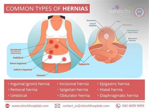 Step By Step Types Of Hernia Diagram Ideas 2022 Technology News Today