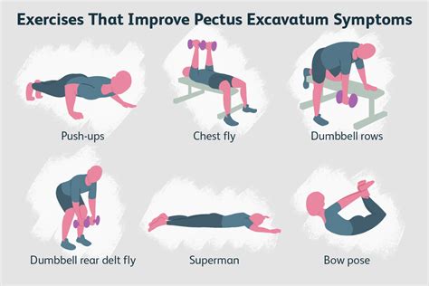 Current Management Of Pectus Excavatum A Review And Update 56 Off