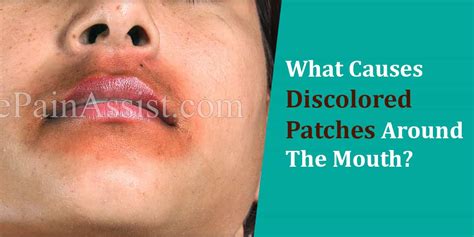 What Causes Discoloration Around The Lips
