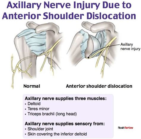 Axillary Nerve Injury Emergency Medicine Medical Knowledge Nursing