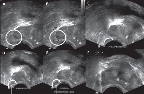 Ultrassonografia Demonstrando Passo A Passo Da Anestesia Local Para