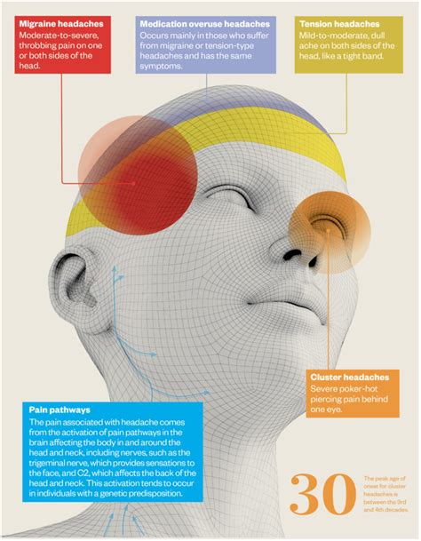 Headache A Visual Guide The Pharmaceutical Journal