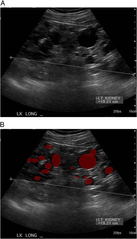 Pictorial Review Renal Ultrasound Clinical Imaging